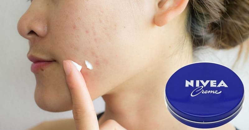 crema nivea acne