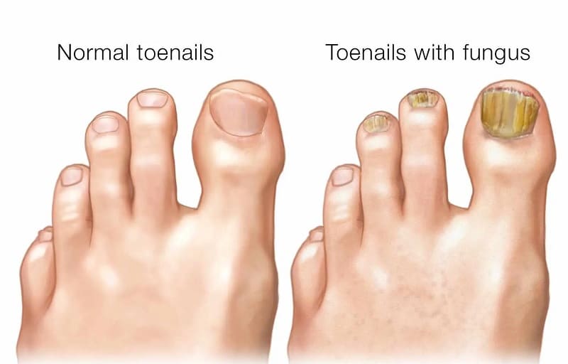 eliminar los hongos de las uñas